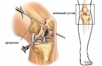 Внутренняя диагностика колена с помощью артроскопии