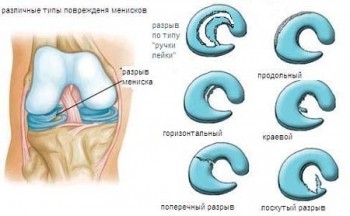Операция на мениске: риски, показания, особенности проведения